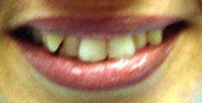 Case 2 before Invisalign